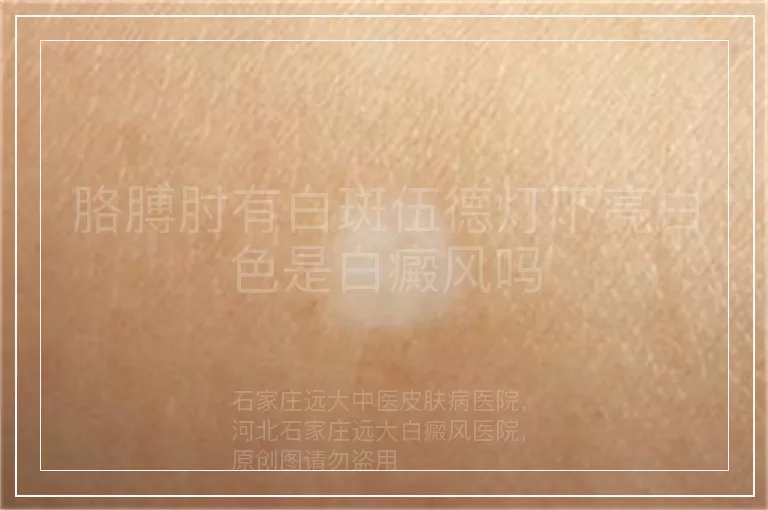 胳膊肘有白斑伍德灯下亮白色是白癜风吗