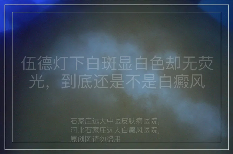 伍德灯下白斑显白色却无荧光,到底还是不是白癜风
