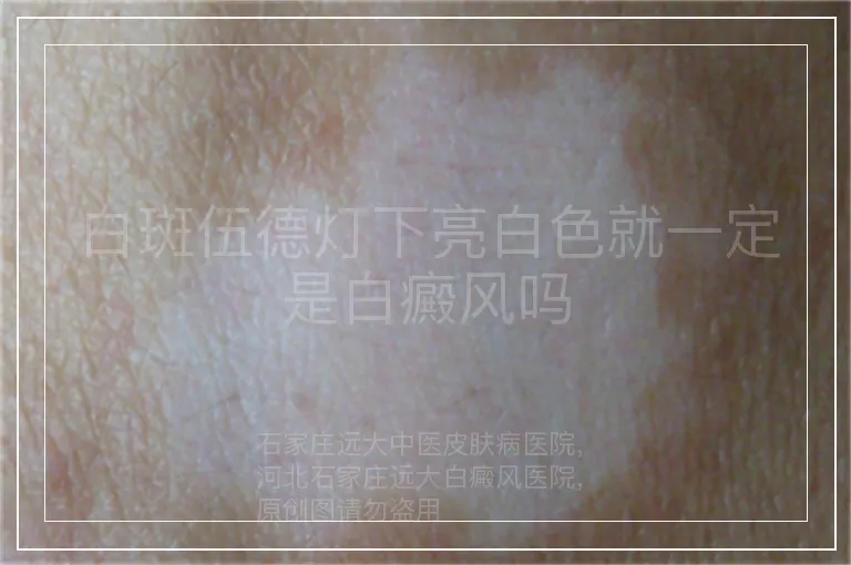 白斑伍德灯下亮白色就一定是白癜风吗