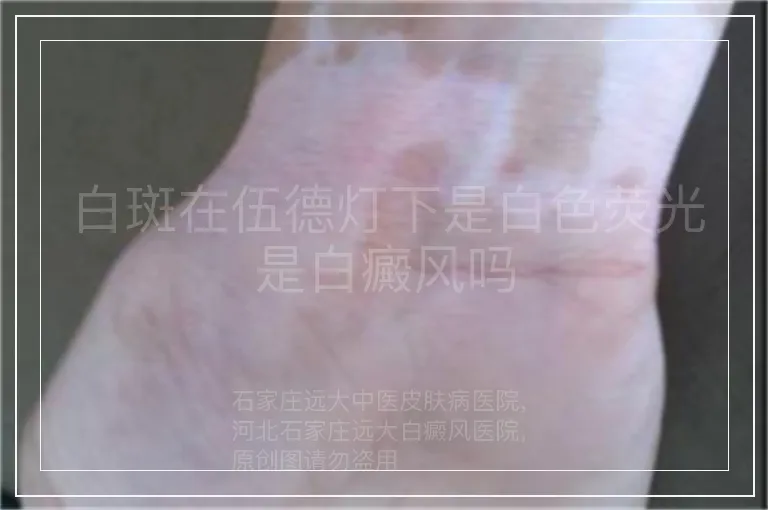 白斑在伍德灯下是白色荧光是白癜风吗