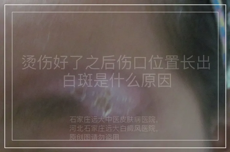 烫伤好了之后伤口位置长出白斑是什么原因