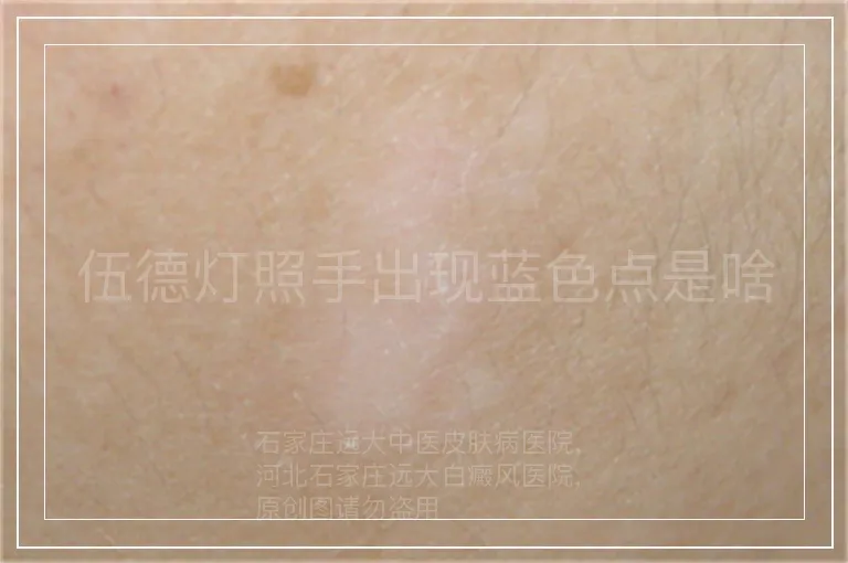 伍德灯照手出现蓝色点是啥
