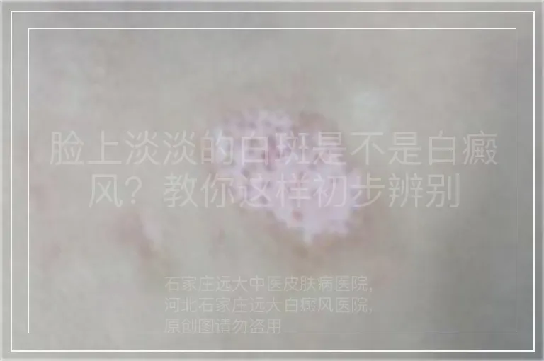 脸上淡淡的白斑是不是白癜风？教你这样初步辨别