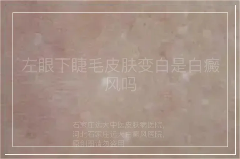 左眼下睫毛皮肤变白是白癜风吗