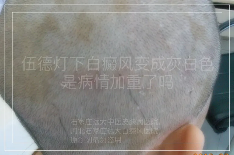 伍德灯下白癜风变成灰白色是病情加重了吗