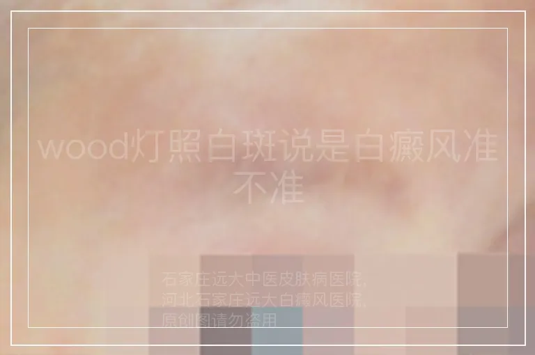 wood灯照白斑说是白癜风准不准