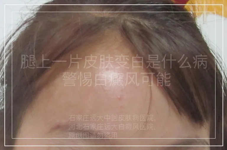 腿上一片皮肤变白是什么病 警惕白癜风可能