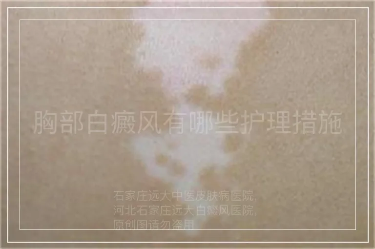 胸部白癜风有哪些护理措施