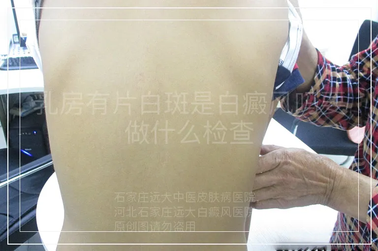 乳房有片白斑是白癜风吗要做什么检查