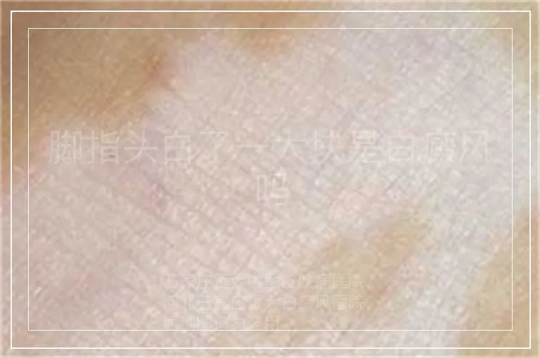 脚指头白了一大块是白癜风吗
