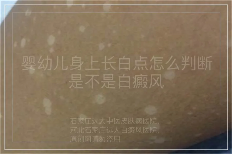 婴幼儿身上长白点怎么判断是不是白癜风