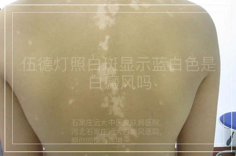 伍德灯照白斑显示蓝白色是白癜风吗