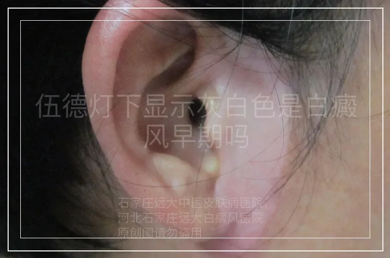 伍德灯下显示灰白色是白癜风早期吗