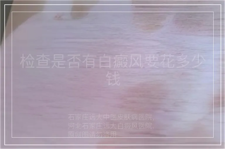 检查是否有白癜风要花多少钱