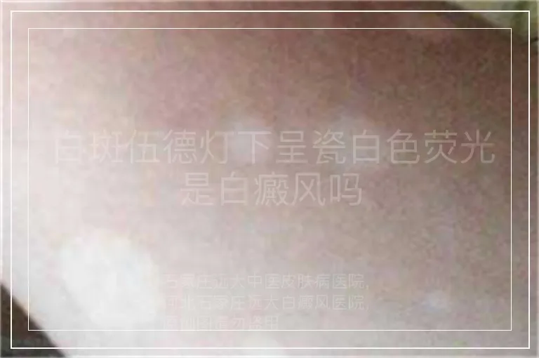 白斑伍德灯下呈瓷白色荧光是白癜风吗