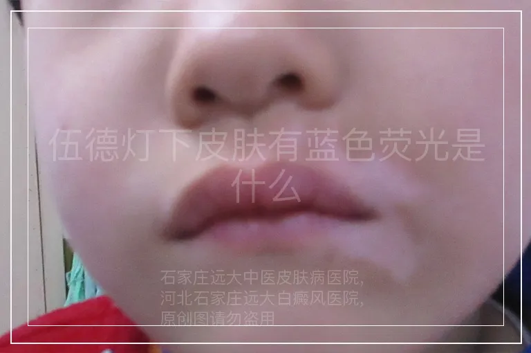 伍德灯下皮肤有蓝色荧光是什么