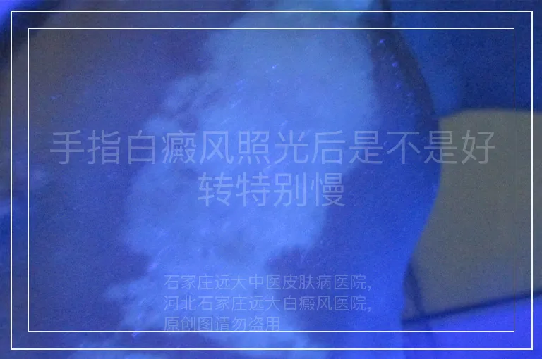 手指白癜风照光后是不是好转特别慢