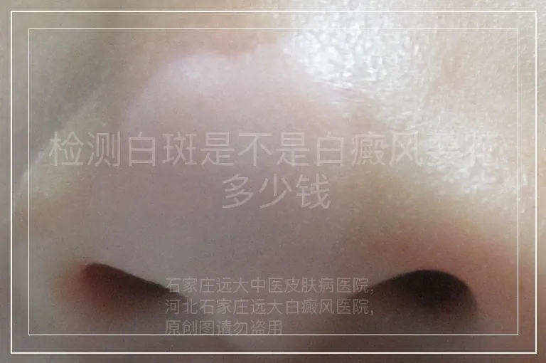检测白斑是不是白癜风要花多少钱