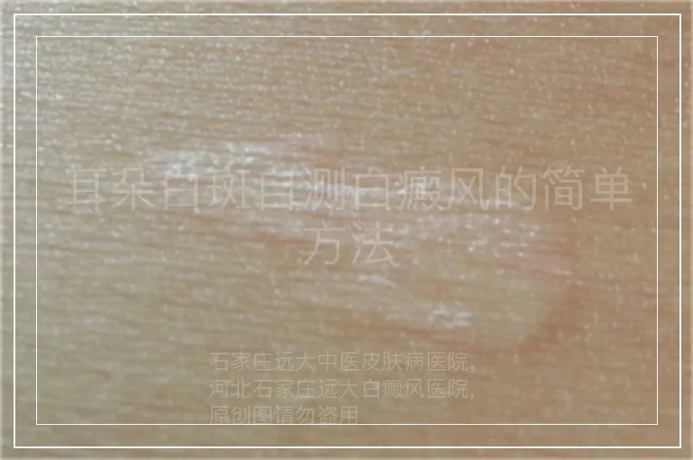 耳朵白斑自测白癜风的简单方法