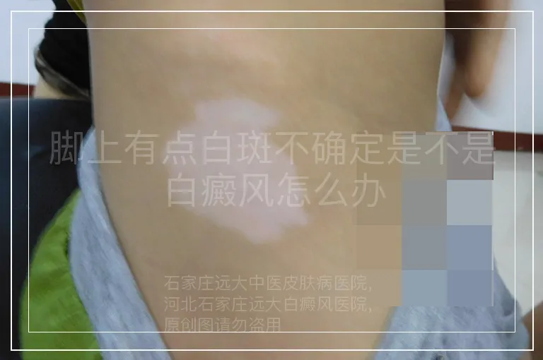 脚上有点白斑不确定是不是白癜风怎么办