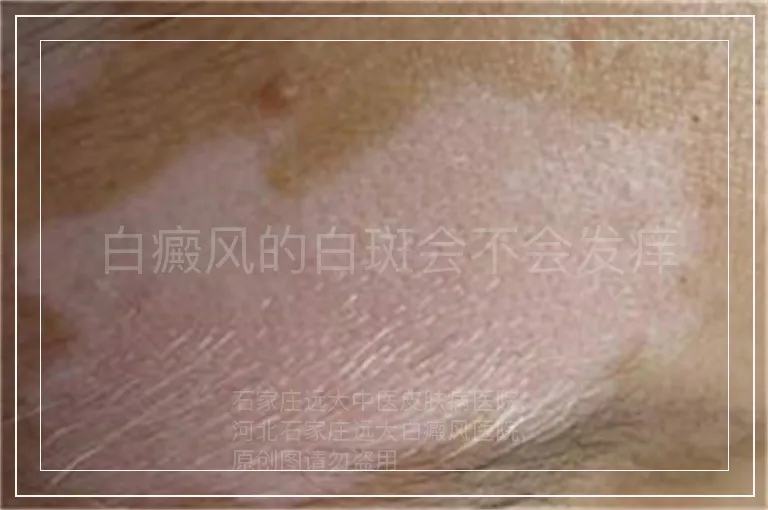 白癜风的白斑会不会发痒