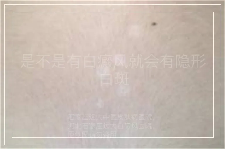 是不是有白癜风就会有隐形白斑