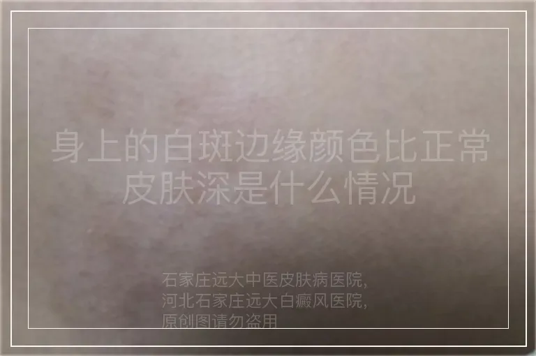 身上的白斑边缘颜色比正常皮肤深是什么情况