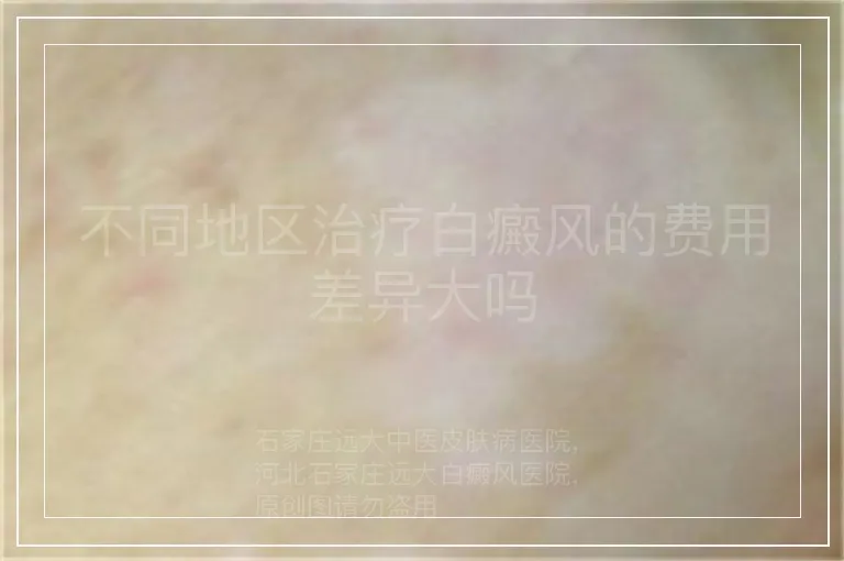 不同地区治疗白癜风的费用差异大吗