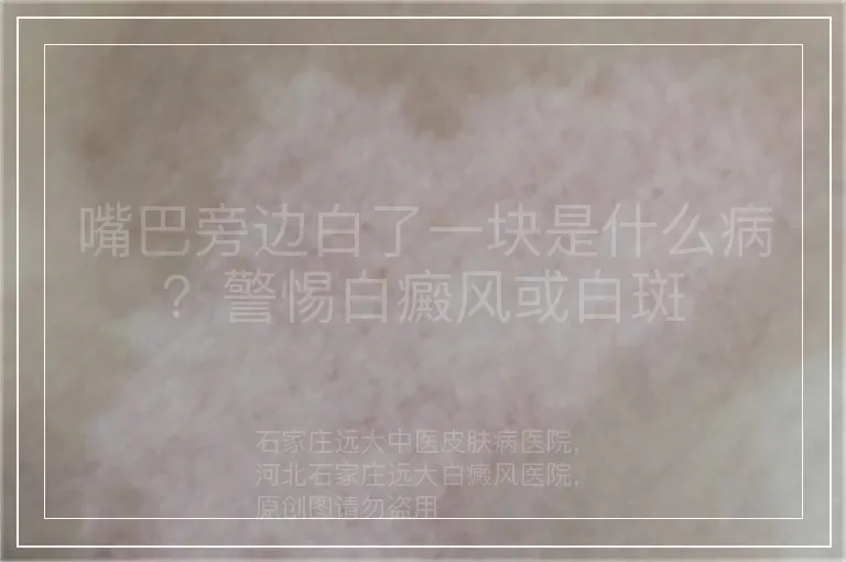 嘴巴旁边白了一块是什么病?警惕白癜风或白斑