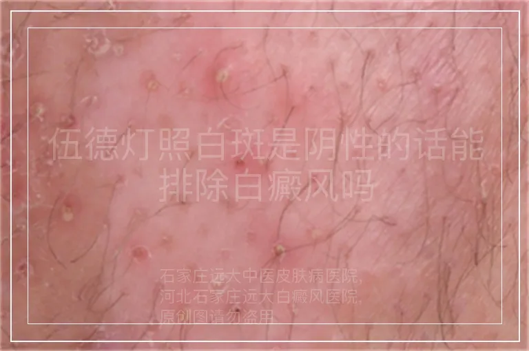 伍德灯照白斑是阴性的话能排除白癜风吗