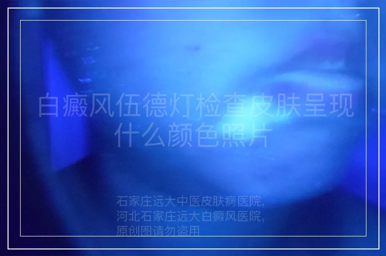 白癜风伍德灯检查皮肤呈现什么颜色照片