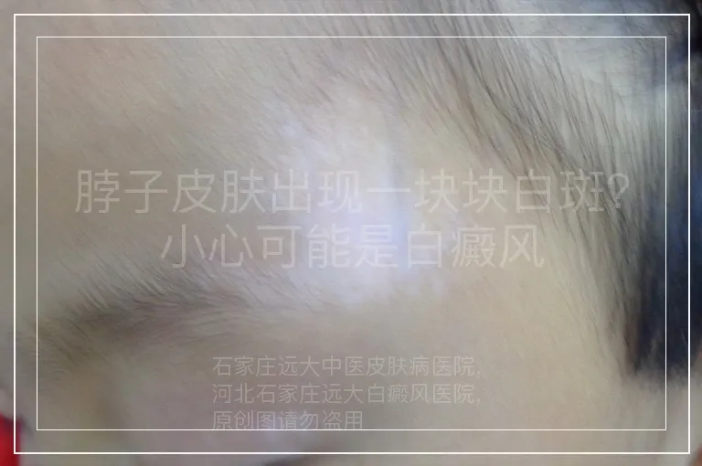 脖子皮肤出现一块块白斑？小心可能是白癜风