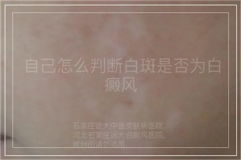 自己怎么判断白斑是否为白癜风