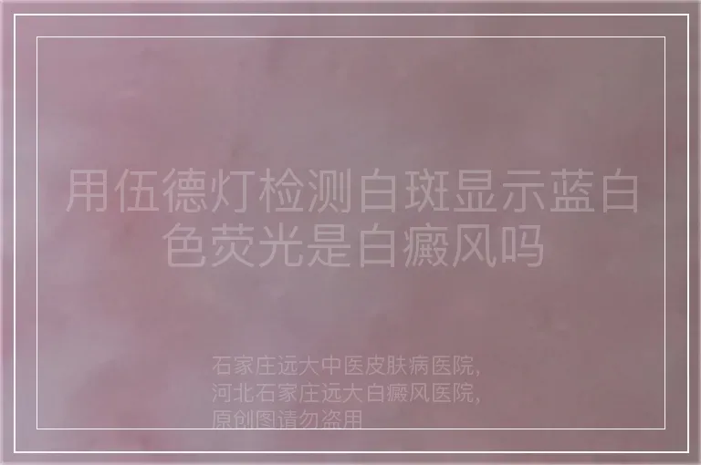 用伍德灯检测白斑显示蓝白色荧光是白癜风吗