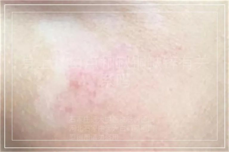 身上长白点和缺铜缺锌有关系吗