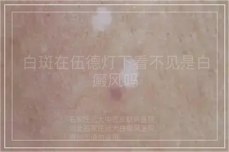 白斑在伍德灯下看不见是白癜风吗