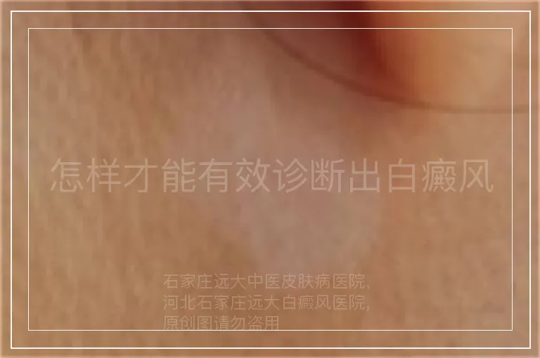 怎样才能有效诊断出白癜风