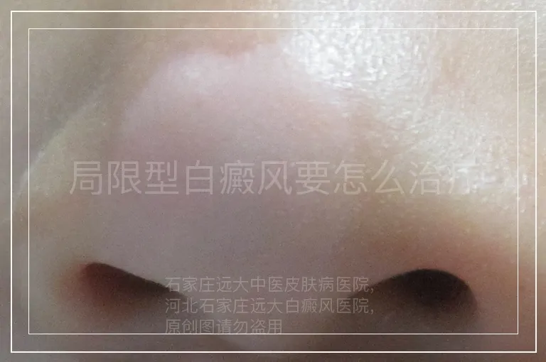 局限型白癜风要怎么治疗