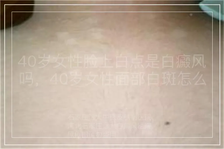40岁女性脸上白点是白癜风吗，40岁女性面部白斑怎么回事，40岁女人脸上白点白斑原因