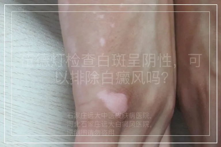 伍德灯检查白斑呈阴性,可以排除白癜风吗?