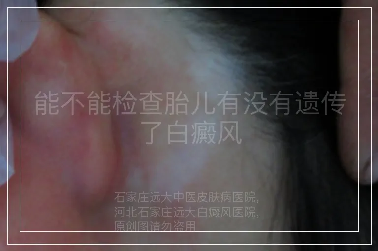 能不能检查胎儿有没有遗传了白癜风