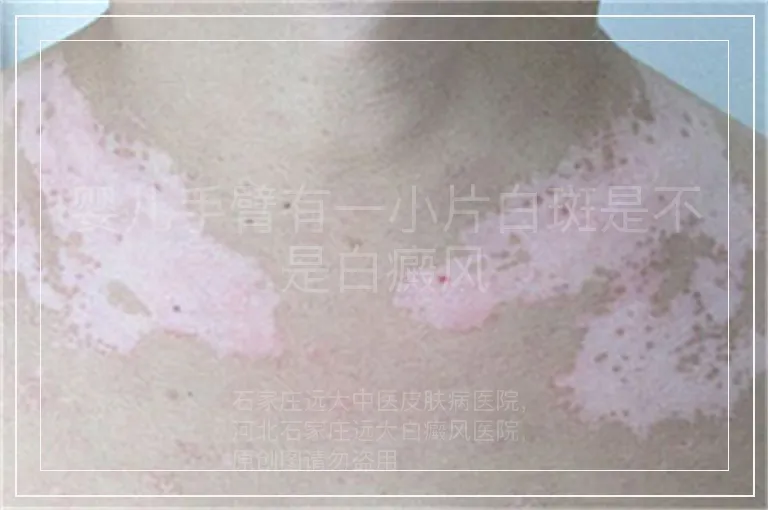 婴儿手臂有一小片白斑是不是白癜风