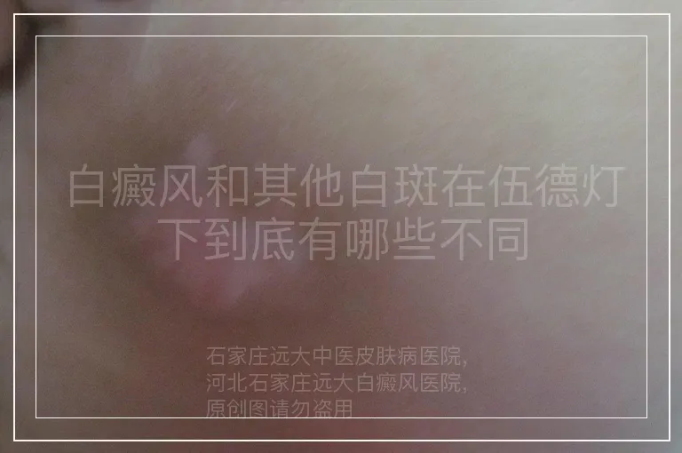 白癜风和其他白斑在伍德灯下到底有哪些不同