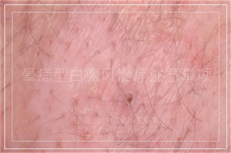 晕痣型白癜风治疗注意事项