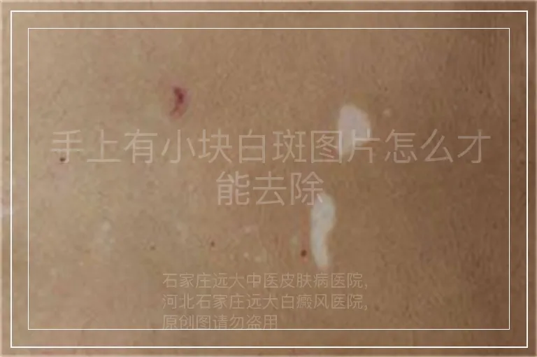 手上有小块白斑图片怎么才能去除