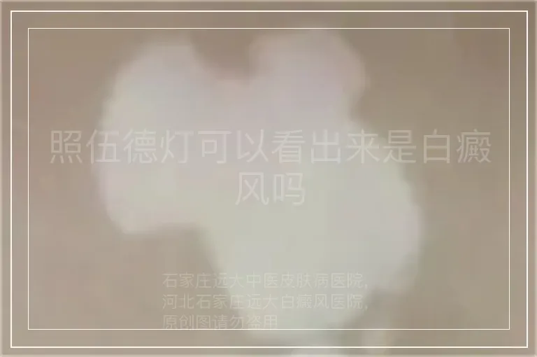 照伍德灯可以看出来是白癜风吗