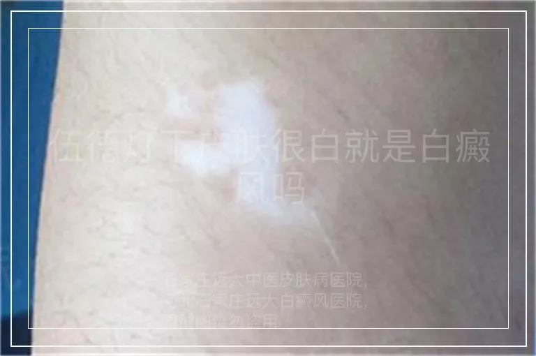伍德灯下皮肤很白就是白癜风吗