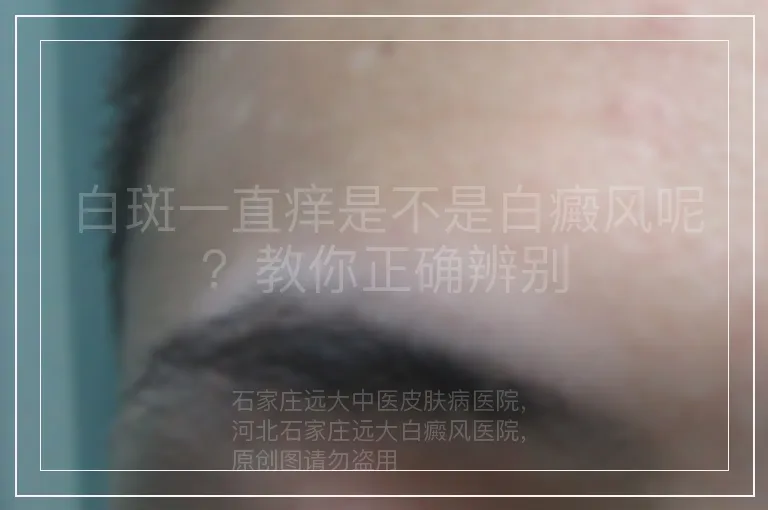 白斑一直痒是不是白癜风呢？教你正确辨别