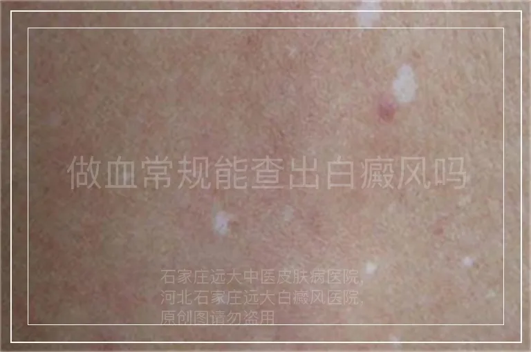 做血常规能查出白癜风吗