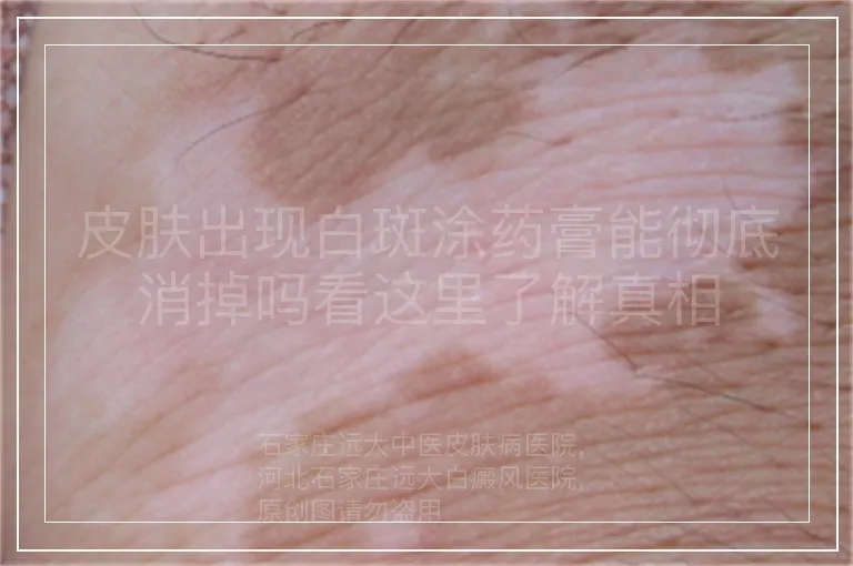 皮肤出现白斑涂药膏能彻底消掉吗看这里了解真相